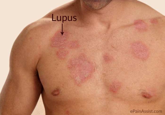 Eklem Ağrılarına Dikkat! Lupus Olabilirsiniz