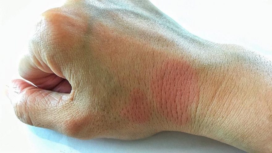 Bu kelebekler stres ile birlikte ortaya çıkıyor; Lupus hastalığı