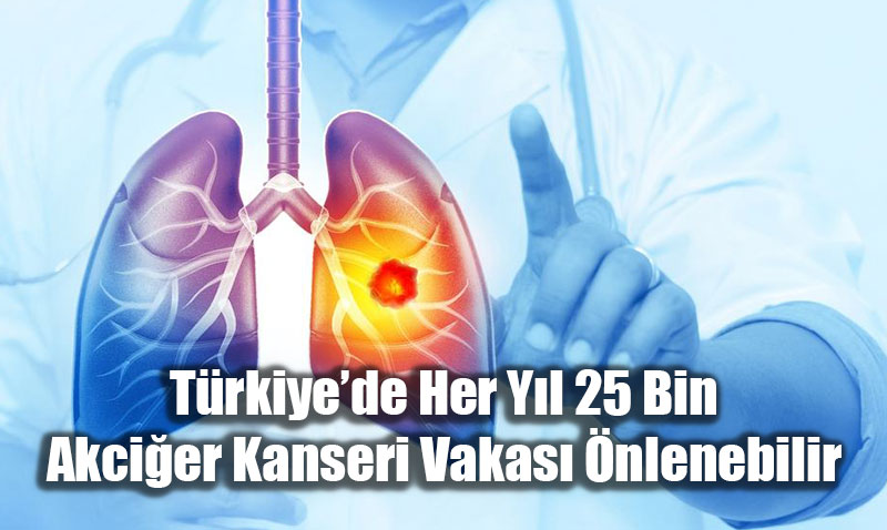 Trkiyede Her Yl 25 Bin Akcier Kanseri Vakas nlenebilir