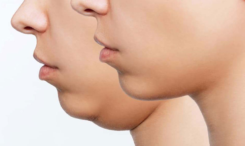 Gıdı Lazer Lipoliz Nedir?