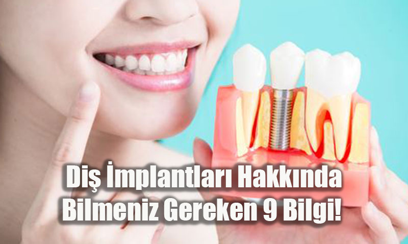 Diş İmplantları Hakkında Bilmeniz Gereken 9 Önemli Bilgi